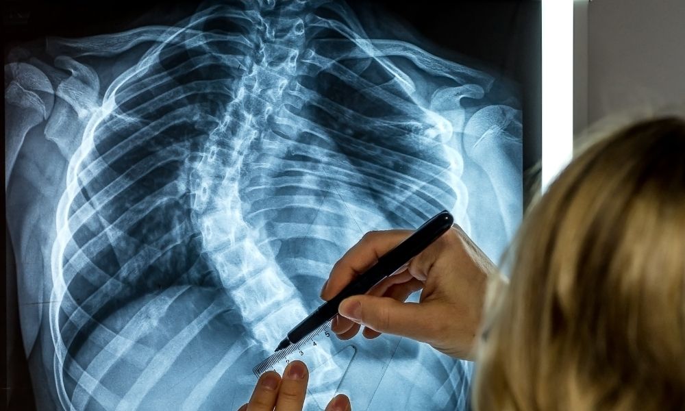 skolyoz-terapi-fizyodiyet-02